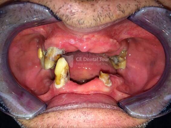 Dental Implant - Before/After - Central European Dental Group