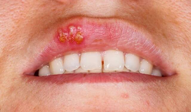 Close up fotografie orální herpes simplex virus infekce — Stock obrázek