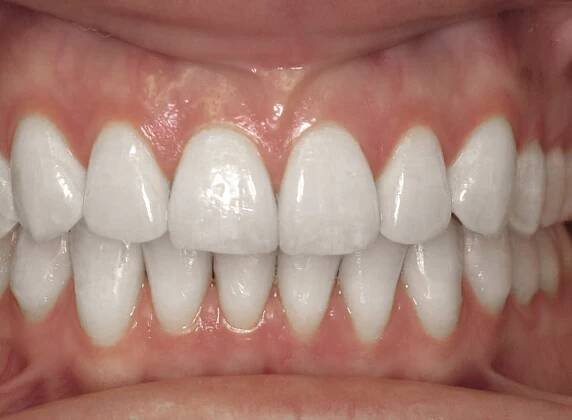 Smile Gallery - Zaytoun Orthodontics