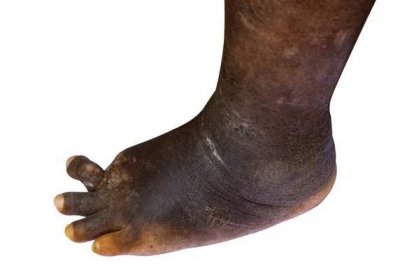 Diabetická zdravotní systém společných podmínek, nohy mají vředy izolovaných na bílém pozadí. — Stock obrázek