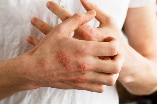 Psoriáza a lupénka - přírodní kosmetika a aromaterapie