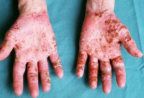 Picture of Palmar Pustulosis   