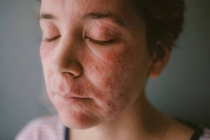Moje milá periorální dermatitida | Zásadně zdravě – Jana Králiková
