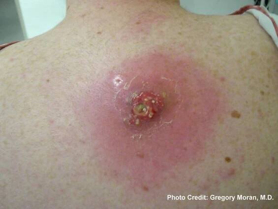 MRSA blister 