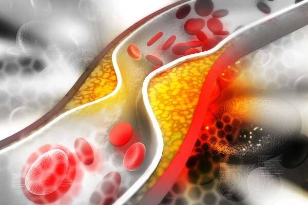 Cholesterol ucpává cévy způsobem, že jednou dojde k infarktu či mrtvici. Naučte se je vyčistit - AAzdraví.cz
