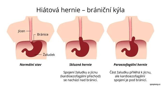 Hiátová hernie – brániční kýla
