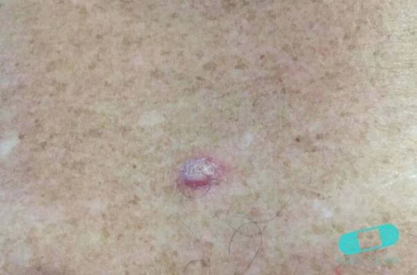 Keratoacanthoma (19) back [ICD-10 L85.8] showing a small, red, dome-shaped lesion with a central crust, or plug of keratin, which is a hallmark feature