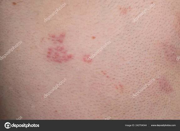 Šindele Nemoc Herpes Zoster Puchýře Těle Virus Varicella Zoster Kožní — Stock Fotografie © gabitodorean #242704044