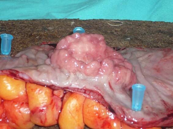 Cancer of the Colon, Macroscopic specimen of the tumor