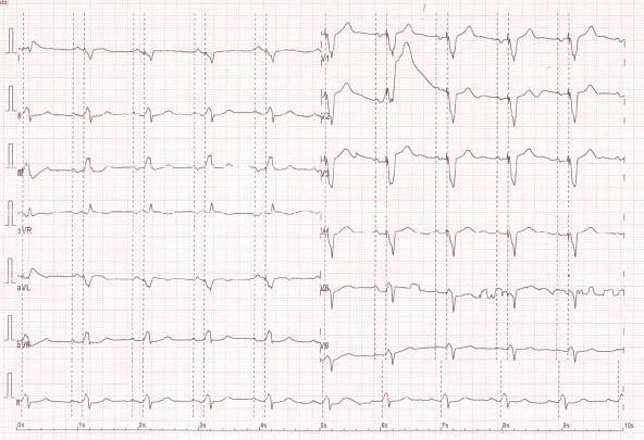 (EKG Kazuistika) Pacemakerový syndrom - Kardioblog