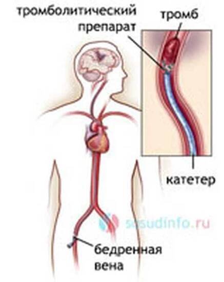 Indikace a komplikace trombolýzy / Trombóza | Užitečné informace a tipy na péči o sebe. Zdraví, výživa a další.