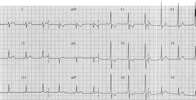 ECG inverted T wave and WPW syndrome type A - left-sided accessory pathway (Bundle of Kent)