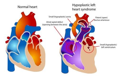 Syndrom hypoplastického levého srdce – Wikipedie