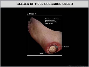 Development of a Heal Ulcer - Stage 4 - Law Office of Andrew A. Ballerini