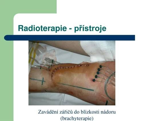 PPT - Radioterapie PowerPoint Presentation, free download - ID:3477966