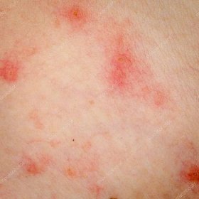 Alergická vyrážka dermatitida ekzémy kůže — Stock Fotografie © panxunbin #18288813