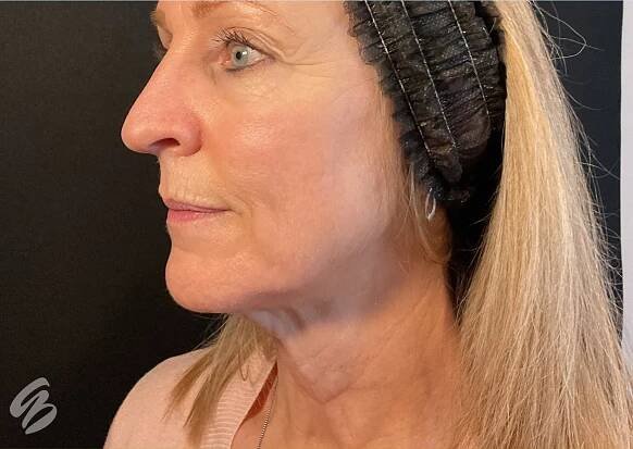 woman's face in side profile showing results after a morpheus8 treatment