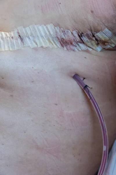 Chirurgické mozků a šev na ženu po operaci — Stock obrázek