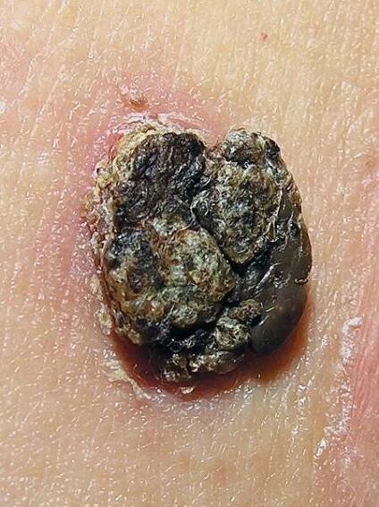 Seborrheic keratosis with rough surface