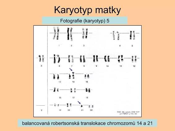Karyotyp matky balancovaná robertsonská translokace chromozomů 14 a 21 Fotografie (karyotyp) 5 