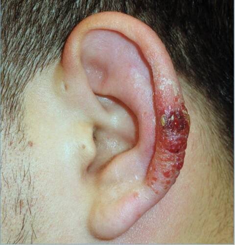 An ear with a raised red and purple ulcer.