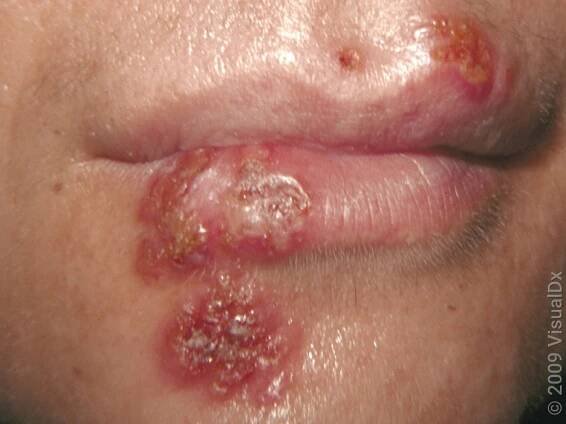 Close-up of the lips with a crusty fever blister. 