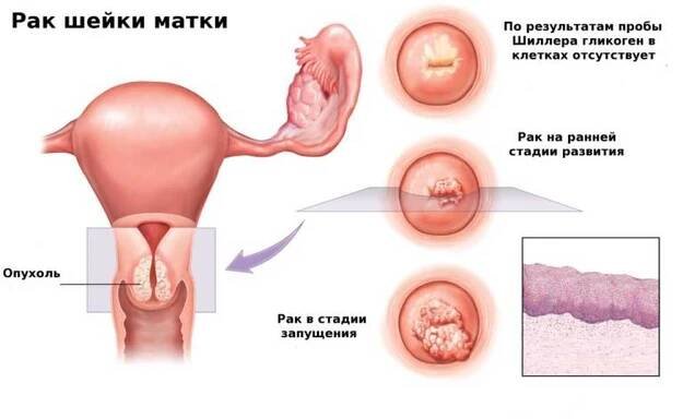 Tahání bolesti v dolní části břicha u žen co dělat? / Fallopian tubes | Užitečné informace a tipy na péči o sebe. Zdraví