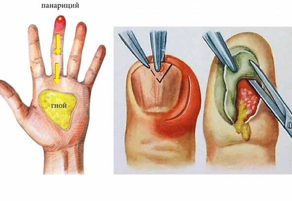 Panaritium může způsobit zánět kostí a kloubů / Články