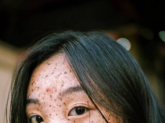 Why Is My Face Breaking Out: 13 Surprising Causes of Acne and How to Treat It