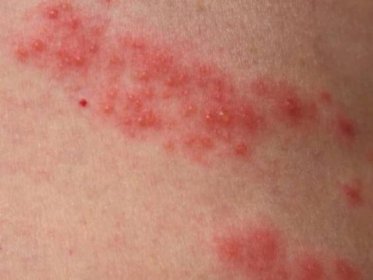 Pylová alergie a možnosti její léčby (domácí i odborné)