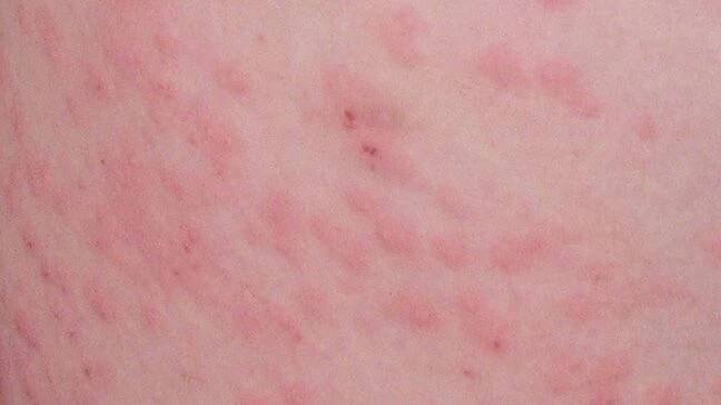 Histoplasmosis: Cause, Types & Complications