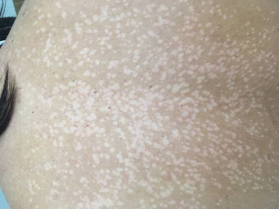 Pityriasis versicolor | Dermaweb