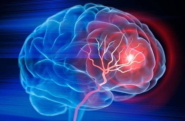 mozková mrtvice - brain - stock snímky, obrázky a fotky