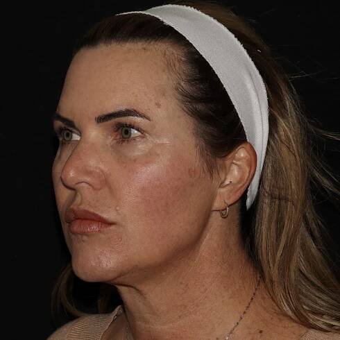 Emface After JH. Non-surgical facelift. mini facelift. needle free face lift. dermatology of the rockies. longmont. Boulder. Erie. Best medical spa near me.