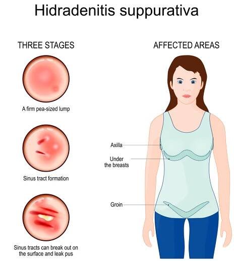 Hidradenitis Suppurativa Treatment In Ayurveda