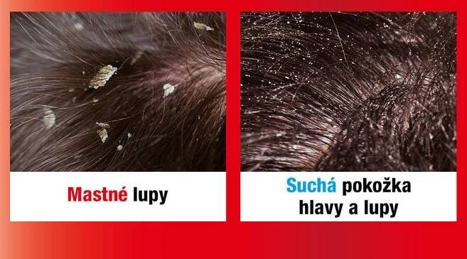 Alpecin Hybrid kofeinový šampon pro svědivou pokožku hlavy