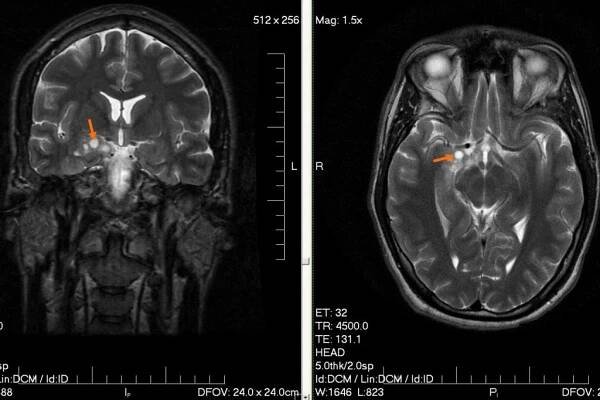 Mozkový nádor typu glioma v počátečním stádiu | iROZHLAS - spolehlivé zprávy