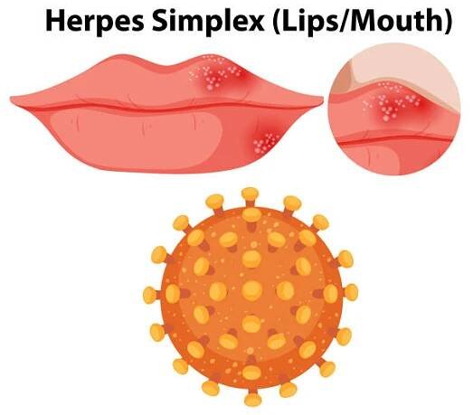 herpes simplex virus (rty/ústa) - opary oparech stock ilustrace