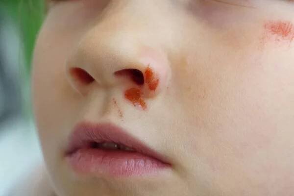 Portrétní dívka s odřeninou pod okem. týrání dětí. rány a oděrky — Stock obrázek
