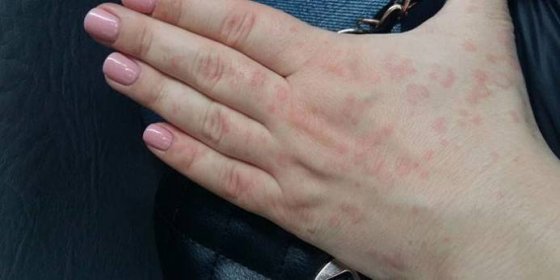 Malé červené skvrny na kůži ženské ruky