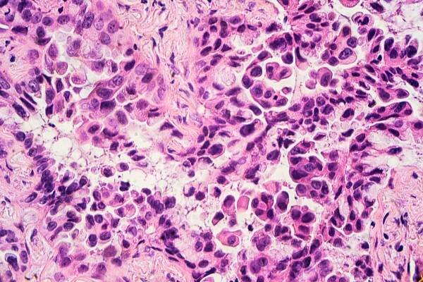 Lung adenocarcinoma