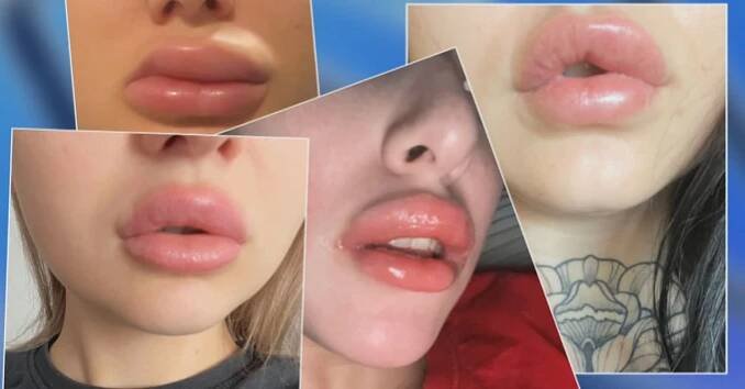 VIDEO: Opuchlé rty, deformace a bolesti. V Česku přibývá falešných plastických klinik