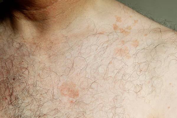 kožní problémy - pityriasis versicolor na hrudi člověka - pityriasis - stock snímky, obrázky a fotky