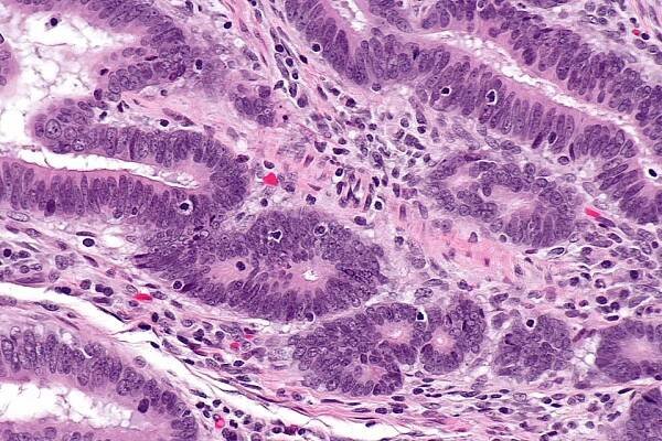 Detail nádorové žlázky, přítomnost tumor infiltrujících lymfocytů.