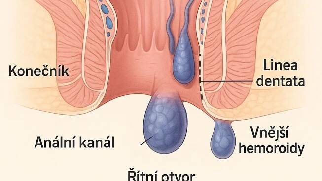 Jak na hemoroidy: Přehled možností léčby. Domácí metody až moderní zákroky