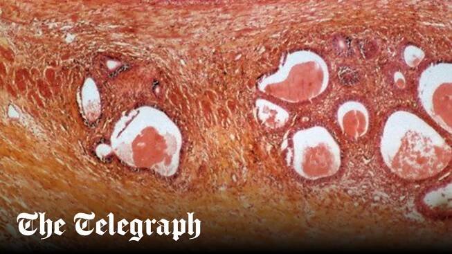 New drug offers promising breakthrough for endometriosis patients