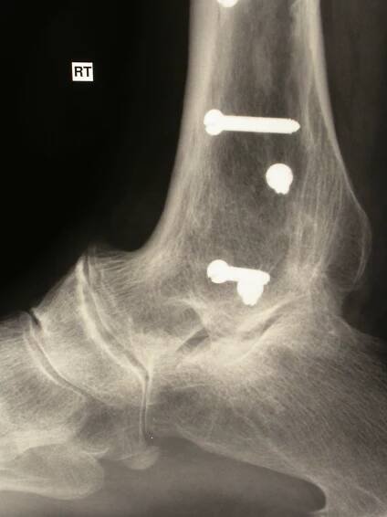 Ankle Replacement - The Foot and Ankle Clinic