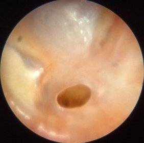 Chronický zánět středního ucha – WikiSkripta