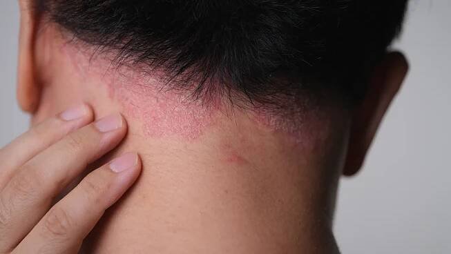 psoriáza na zádech člověka. kůže s psoriázou. - seboroická dermatitida - stock snímky, obrázky a fotky