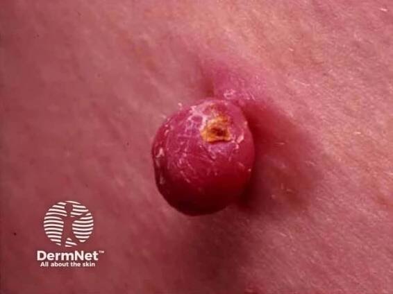 Pyogenic granuloma